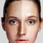 Ways To Remove Acne Scars And Freckles